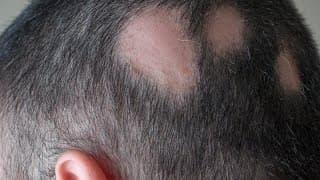 Mancha na área do cabelo